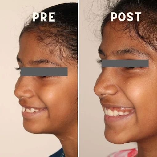Facial Profile Transformation