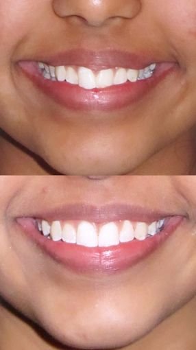 Smile Design Result