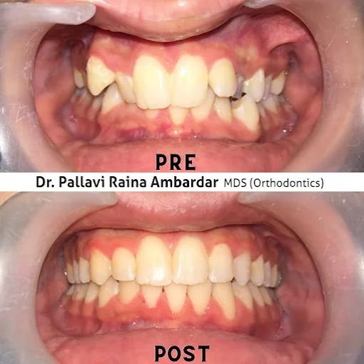 Orthodontic Smile Correction