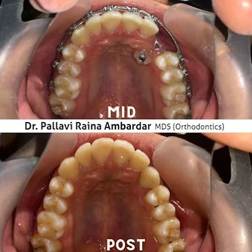 Dental Alignment Treatment