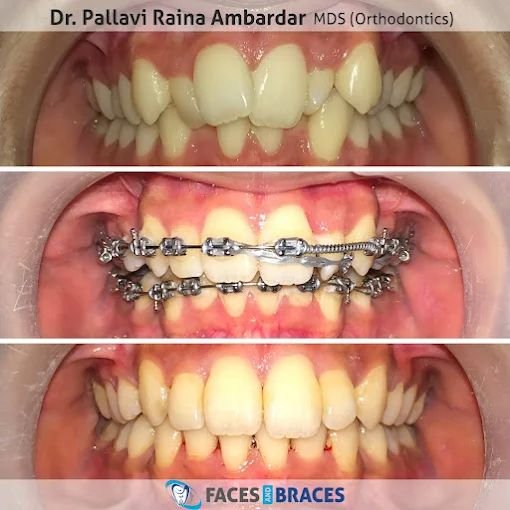 Braces Treatment Result