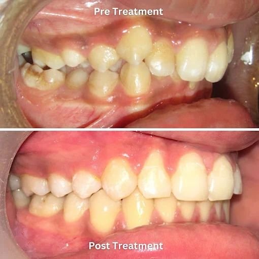 Teeth Alignment Result